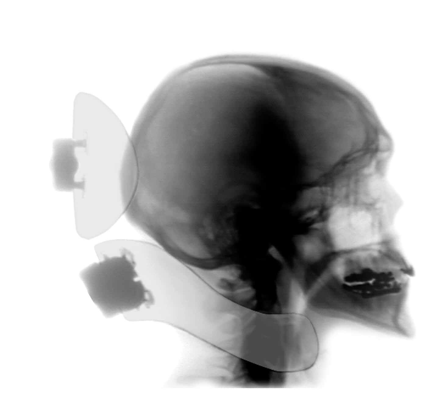 Whitmyer Anterior Support